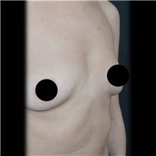 Breast Augmentation Before Photo by Cem Berkay SINACI, MD; Istanbul, M - Case 51012