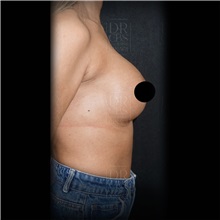 Breast Augmentation After Photo by Cem Berkay SINACI, MD; Istanbul, M - Case 51014