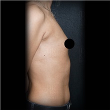 Breast Augmentation Before Photo by Cem Berkay SINACI, MD; Istanbul, M - Case 51014