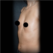 Breast Augmentation Before Photo by Cem Berkay SINACI, MD; Istanbul, M - Case 51014