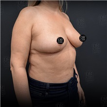 Breast Reduction After Photo by Cem Berkay SINACI, MD; Istanbul, M - Case 51019