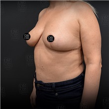 Breast Reduction After Photo by Cem Berkay SINACI, MD; Istanbul, M - Case 51019