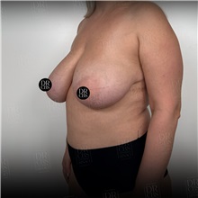 Breast Reduction Before Photo by Cem Berkay SINACI, MD; Istanbul, M - Case 51019