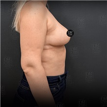 Breast Reduction After Photo by Cem Berkay SINACI, MD; Istanbul, M - Case 51019