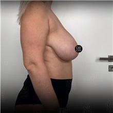 Breast Reduction Before Photo by Cem Berkay SINACI, MD; Istanbul, M - Case 51019