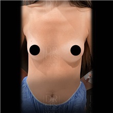 Breast Augmentation Before Photo by Cem Berkay SINACI, MD; Istanbul, M - Case 51015