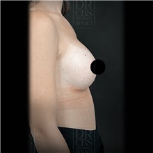 Breast Augmentation After Photo by Cem Berkay SINACI, MD; Istanbul, M - Case 51015