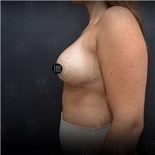 Breast Reduction After Photo by Cem Berkay SINACI, MD; Istanbul, M - Case 51020