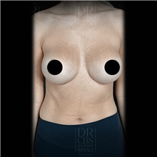 Breast Augmentation After Photo by Cem Berkay SINACI, MD; Istanbul, M - Case 51017