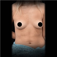 Breast Augmentation Before Photo by Cem Berkay SINACI, MD; Istanbul, M - Case 51017