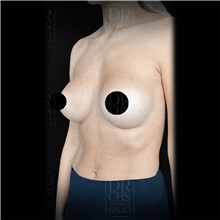 Breast Augmentation After Photo by Cem Berkay SINACI, MD; Istanbul, M - Case 51017