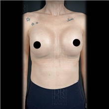 Breast Augmentation After Photo by Cem Berkay SINACI, MD; Istanbul, M - Case 51018