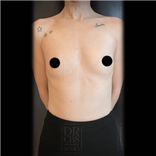 Breast Augmentation Before Photo by Cem Berkay SINACI, MD; Istanbul, M - Case 51018