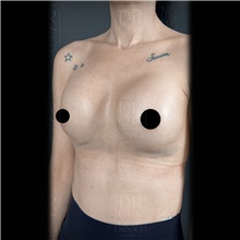 Breast Augmentation After Photo by Cem Berkay SINACI, MD; Istanbul, M - Case 51018