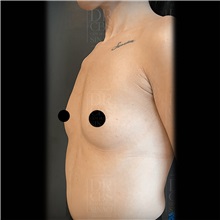 Breast Augmentation Before Photo by Cem Berkay SINACI, MD; Istanbul, M - Case 51018