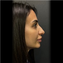 Rhinoplasty Before Photo by Cem Berkay SINACI, MD; Istanbul, M - Case 51021