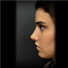 Rhinoplasty After Photo by Cem Berkay SINACI, MD; Istanbul, M - Case 51022