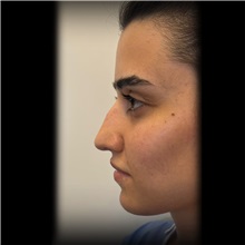 Rhinoplasty Before Photo by Cem Berkay SINACI, MD; Istanbul, M - Case 51022