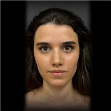 Rhinoplasty After Photo by Cem Berkay SINACI, MD; Istanbul, M - Case 51022