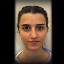 Rhinoplasty Before Photo by Cem Berkay SINACI, MD; Istanbul, M - Case 51022