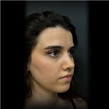 Rhinoplasty After Photo by Cem Berkay SINACI, MD; Istanbul, M - Case 51022