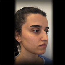 Rhinoplasty Before Photo by Cem Berkay SINACI, MD; Istanbul, M - Case 51022