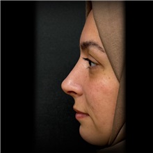 Rhinoplasty After Photo by Cem Berkay SINACI, MD; Istanbul, M - Case 51023