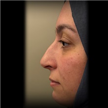 Rhinoplasty Before Photo by Cem Berkay SINACI, MD; Istanbul, M - Case 51023