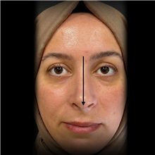 Rhinoplasty After Photo by Cem Berkay SINACI, MD; Istanbul, M - Case 51023