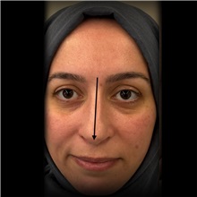 Rhinoplasty Before Photo by Cem Berkay SINACI, MD; Istanbul, M - Case 51023