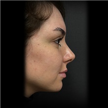 Rhinoplasty After Photo by Cem Berkay SINACI, MD; Istanbul, M - Case 51025