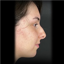 Rhinoplasty Before Photo by Cem Berkay SINACI, MD; Istanbul, M - Case 51025
