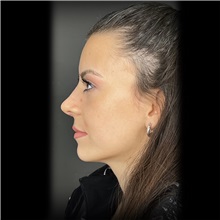 Rhinoplasty After Photo by Cem Berkay SINACI, MD; Istanbul, M - Case 51024