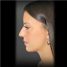 Rhinoplasty Before Photo by Cem Berkay SINACI, MD; Istanbul, M - Case 51024