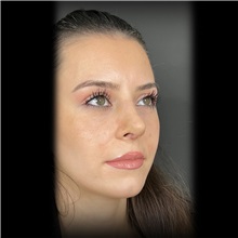 Rhinoplasty After Photo by Cem Berkay SINACI, MD; Istanbul, M - Case 51024