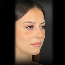 Rhinoplasty Before Photo by Cem Berkay SINACI, MD; Istanbul, M - Case 51024