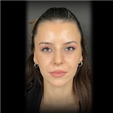 Rhinoplasty After Photo by Cem Berkay SINACI, MD; Istanbul, M - Case 51024