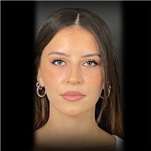 Rhinoplasty Before Photo by Cem Berkay SINACI, MD; Istanbul, M - Case 51024