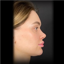 Rhinoplasty After Photo by Cem Berkay SINACI, MD; Istanbul, M - Case 51028