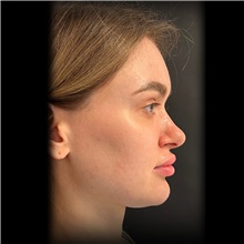 Rhinoplasty Before Photo by Cem Berkay SINACI, MD; Istanbul, M - Case 51028