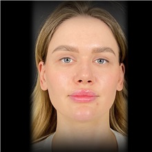 Rhinoplasty After Photo by Cem Berkay SINACI, MD; Istanbul, M - Case 51028