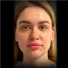 Rhinoplasty Before Photo by Cem Berkay SINACI, MD; Istanbul, M - Case 51028