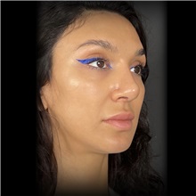 Rhinoplasty After Photo by Cem Berkay SINACI, MD; Istanbul, M - Case 51026