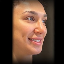 Rhinoplasty Before Photo by Cem Berkay SINACI, MD; Istanbul, M - Case 51026