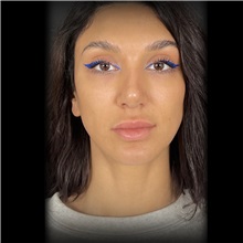 Rhinoplasty After Photo by Cem Berkay SINACI, MD; Istanbul, M - Case 51026