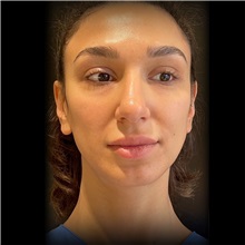 Rhinoplasty Before Photo by Cem Berkay SINACI, MD; Istanbul, M - Case 51026