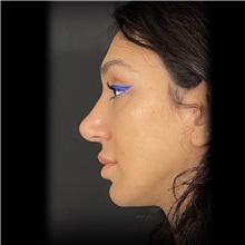 Rhinoplasty After Photo by Cem Berkay SINACI, MD; Istanbul, M - Case 51026