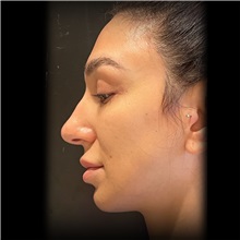 Rhinoplasty Before Photo by Cem Berkay SINACI, MD; Istanbul, M - Case 51026