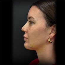 Chin Surgery After Photo by Cem Berkay SINACI, MD; Istanbul, M - Case 51030