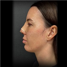Chin Surgery Before Photo by Cem Berkay SINACI, MD; Istanbul, M - Case 51030